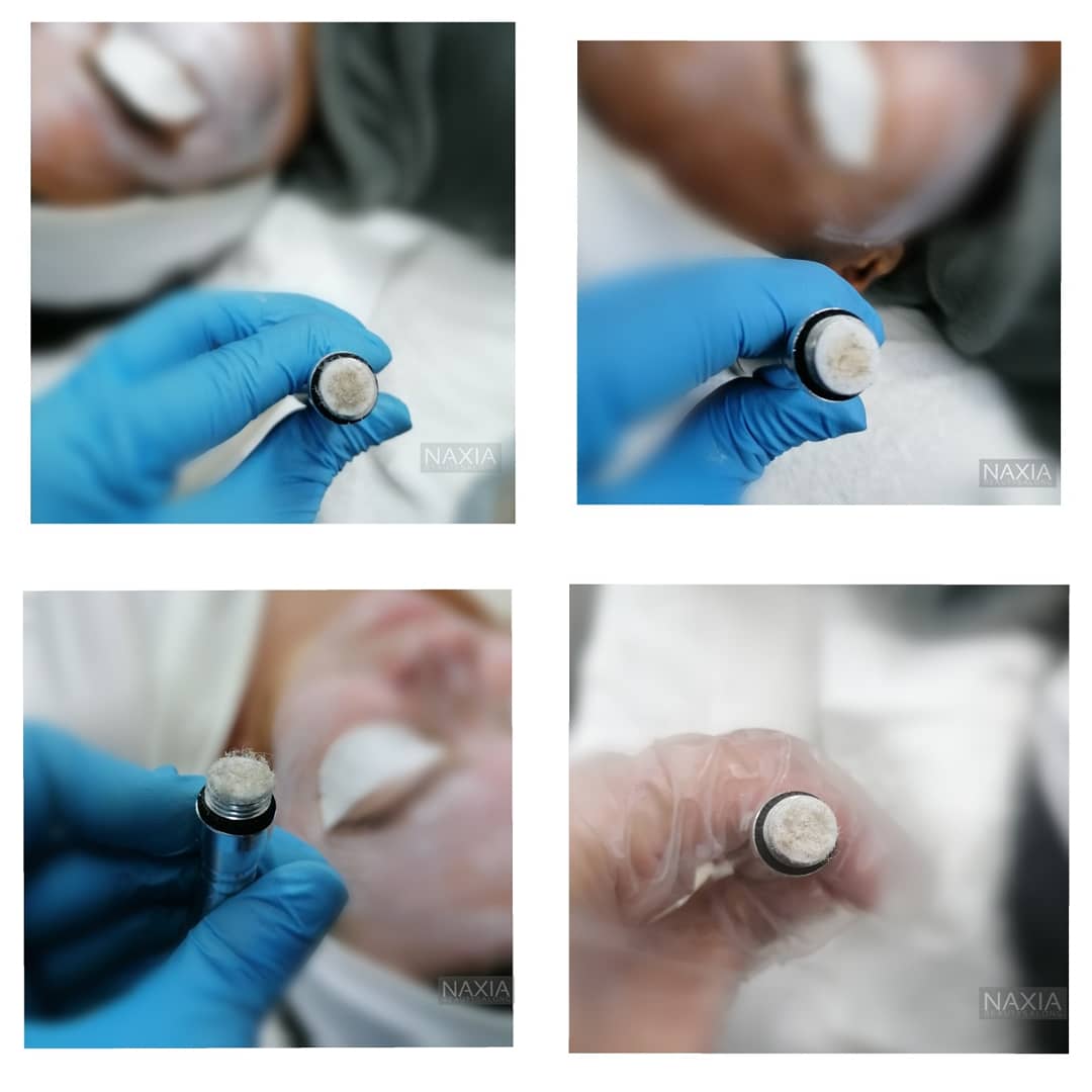 Before treatment