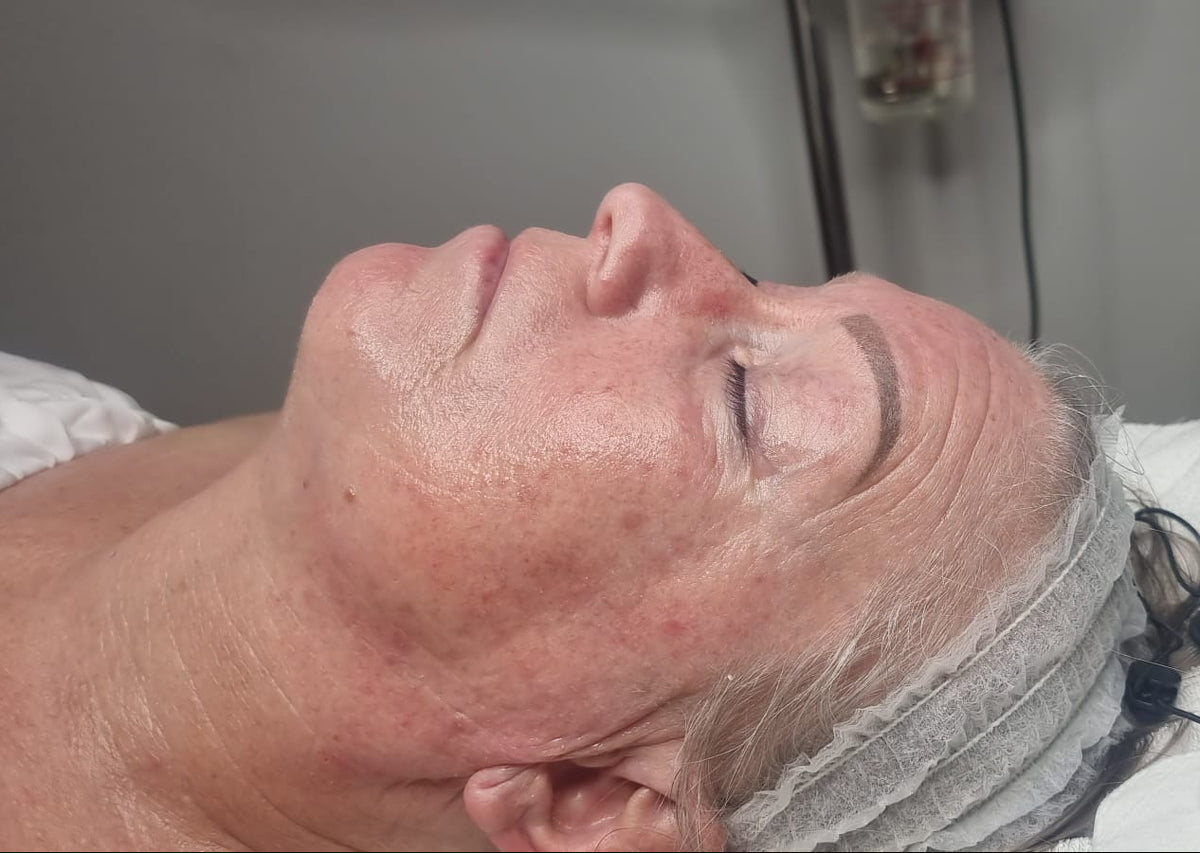 After treatment